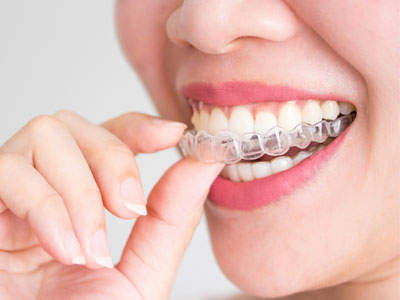 Clear Aligner Therapy1